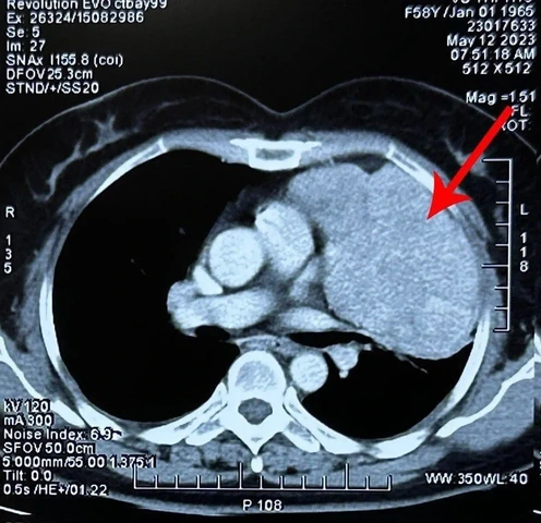 Nhận Diện Hình Ảnh U Phổi Trên Ct: Đặc Điểm, Dấu Hiệu Và Cách Đọc Kết Quả Chẩn Đoán Nhận Diện Hình Ảnh U Phổi Trên Ct: Đặc Điểm, Dấu Hiệu Và Cách Đọc Kết Quả Chẩn Đoán