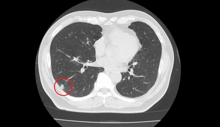 Nhận Diện Hình Ảnh U Phổi Trên Ct: Đặc Điểm, Dấu Hiệu Và Cách Đọc Kết Quả Chẩn Đoán Nhận Diện Hình Ảnh U Phổi Trên Ct: Đặc Điểm, Dấu Hiệu Và Cách Đọc Kết Quả Chẩn Đoán