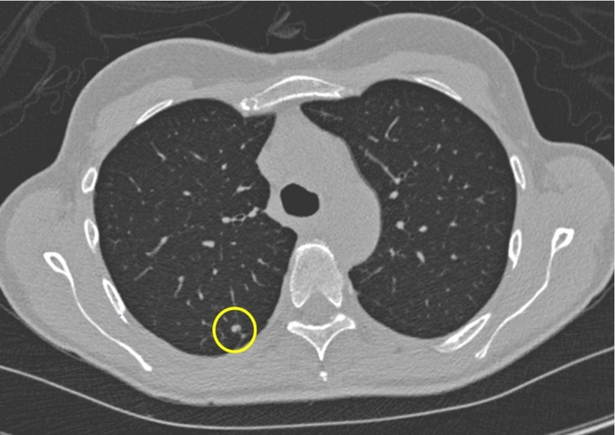 Nhận Diện Hình Ảnh U Phổi Trên Ct: Đặc Điểm, Dấu Hiệu Và Cách Đọc Kết Quả Chẩn Đoán Nhận Diện Hình Ảnh U Phổi Trên Ct: Đặc Điểm, Dấu Hiệu Và Cách Đọc Kết Quả Chẩn Đoán