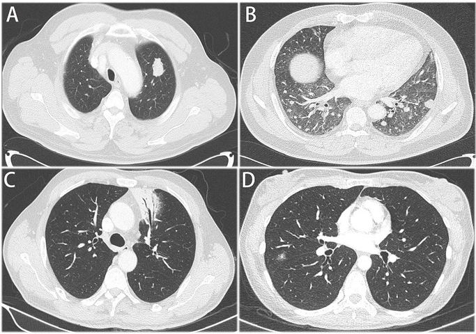 Nhận Diện Hình Ảnh U Phổi Trên Ct: Đặc Điểm, Dấu Hiệu Và Cách Đọc Kết Quả Chẩn Đoán Nhận Diện Hình Ảnh U Phổi Trên Ct: Đặc Điểm, Dấu Hiệu Và Cách Đọc Kết Quả Chẩn Đoán