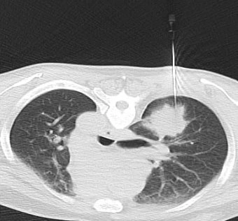 Nhận Diện Hình Ảnh U Phổi Trên Ct: Đặc Điểm, Dấu Hiệu Và Cách Đọc Kết Quả Chẩn Đoán Nhận Diện Hình Ảnh U Phổi Trên Ct: Đặc Điểm, Dấu Hiệu Và Cách Đọc Kết Quả Chẩn Đoán