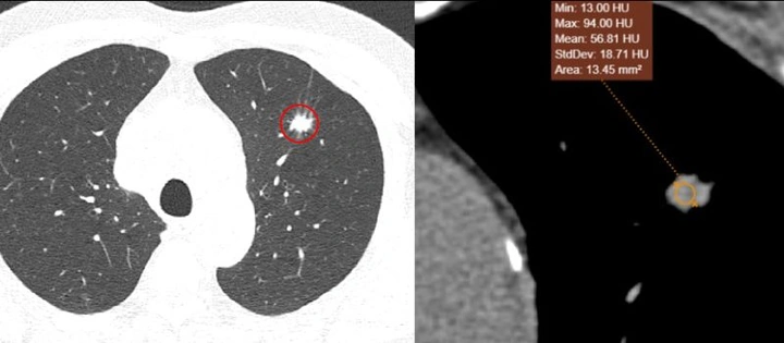 Nhận Diện Hình Ảnh U Phổi Trên Ct: Đặc Điểm, Dấu Hiệu Và Cách Đọc Kết Quả Chẩn Đoán Nhận Diện Hình Ảnh U Phổi Trên Ct: Đặc Điểm, Dấu Hiệu Và Cách Đọc Kết Quả Chẩn Đoán