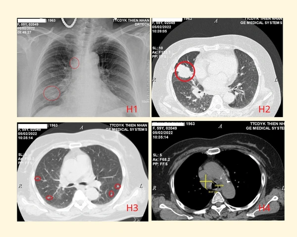 Nhận Diện Hình Ảnh U Phổi Trên Ct: Đặc Điểm, Dấu Hiệu Và Cách Đọc Kết Quả Chẩn Đoán Nhận Diện Hình Ảnh U Phổi Trên Ct: Đặc Điểm, Dấu Hiệu Và Cách Đọc Kết Quả Chẩn Đoán