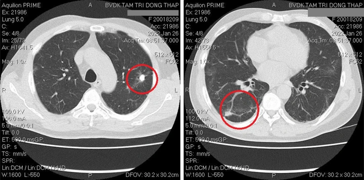 Nhận Diện Hình Ảnh U Phổi Trên Ct: Đặc Điểm, Dấu Hiệu Và Cách Đọc Kết Quả Chẩn Đoán Nhận Diện Hình Ảnh U Phổi Trên Ct: Đặc Điểm, Dấu Hiệu Và Cách Đọc Kết Quả Chẩn Đoán