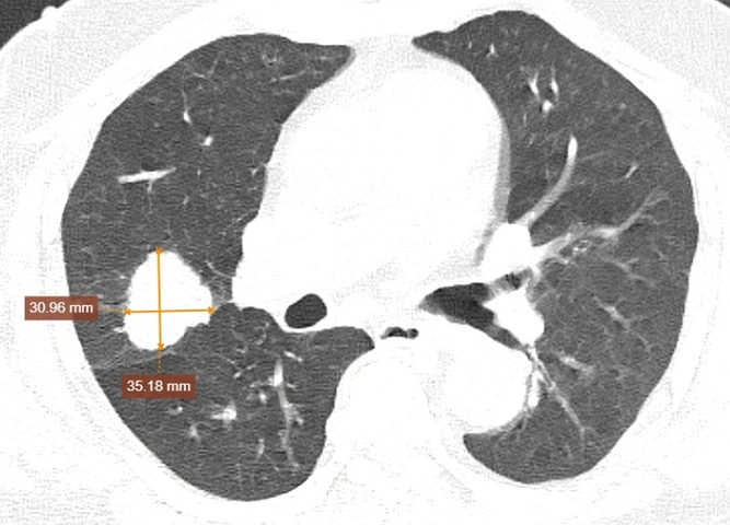 Nhận Diện Hình Ảnh U Phổi Trên Ct: Đặc Điểm, Dấu Hiệu Và Cách Đọc Kết Quả Chẩn Đoán Nhận Diện Hình Ảnh U Phổi Trên Ct: Đặc Điểm, Dấu Hiệu Và Cách Đọc Kết Quả Chẩn Đoán