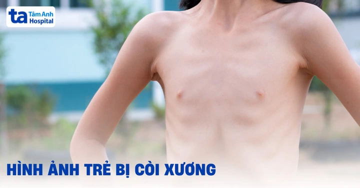 Hình Ảnh Bệnh Còi Xương: Nhận Biết Dấu Hiệu, Nguyên Nhân Và Cách Phòng Ngừa Cho Trẻ