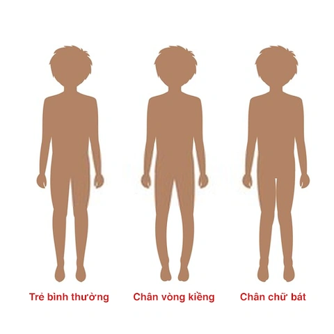 Hình Ảnh Bệnh Còi Xương: Nhận Biết Dấu Hiệu, Nguyên Nhân Và Cách Phòng Ngừa Cho Trẻ