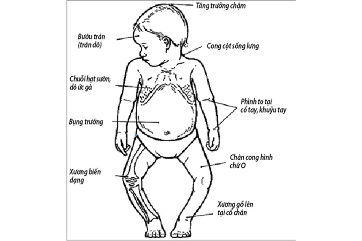 Hình Ảnh Bệnh Còi Xương: Nhận Biết Dấu Hiệu, Nguyên Nhân Và Cách Phòng Ngừa Cho Trẻ