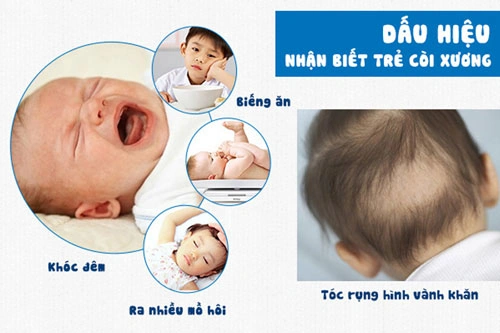Hình Ảnh Bệnh Còi Xương: Nhận Biết Dấu Hiệu, Nguyên Nhân Và Cách Phòng Ngừa Cho Trẻ