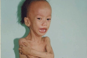 Hình Ảnh Bệnh Còi Xương: Nhận Biết Dấu Hiệu, Nguyên Nhân Và Cách Phòng Ngừa Cho Trẻ