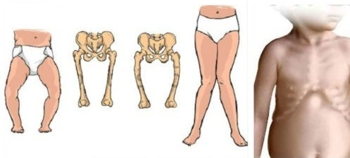Hình Ảnh Bệnh Còi Xương: Nhận Biết Dấu Hiệu, Nguyên Nhân Và Cách Phòng Ngừa Cho Trẻ