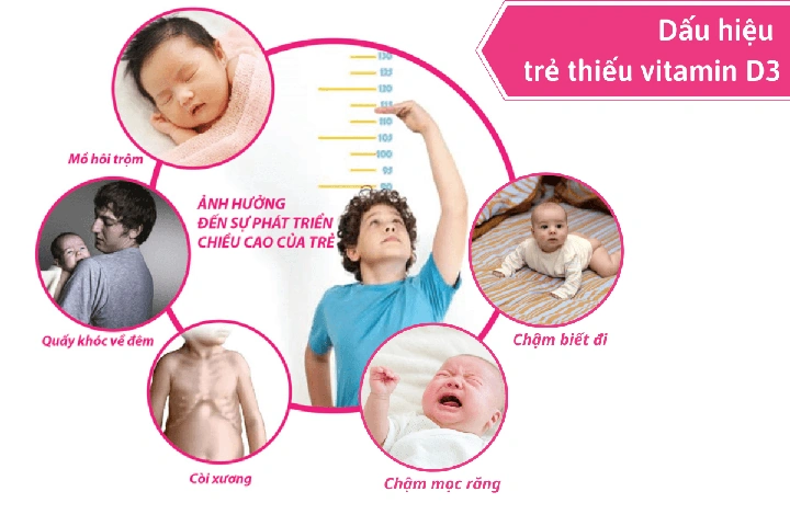 Hình Ảnh Bệnh Còi Xương: Nhận Biết Dấu Hiệu, Nguyên Nhân Và Cách Phòng Ngừa Cho Trẻ