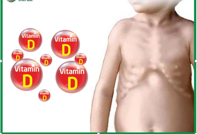 Hình Ảnh Bệnh Còi Xương: Nhận Biết Dấu Hiệu, Nguyên Nhân Và Cách Phòng Ngừa Cho Trẻ