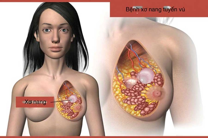 Hiểu Rõ Hình Ảnh Vú Phụ Nữ: Các Loại Hình Dạng, Kích Cỡ, Núm Vú Và Dấu Hiệu Bất Thường