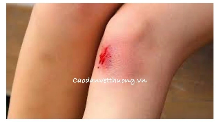 Tổng Hợp Hình Ảnh Vết Thương Tai Nạn Té Xe Thật: Từ Trầy Xước Nhẹ Đến Chấn Thương Nặng Cho Nam Nữ