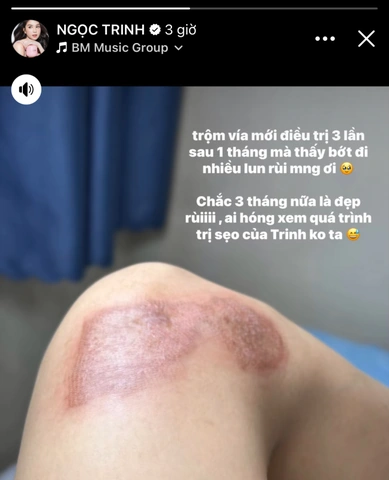 Tổng Hợp Hình Ảnh Vết Thương Tai Nạn Té Xe Thật: Từ Trầy Xước Nhẹ Đến Chấn Thương Nặng Cho Nam Nữ