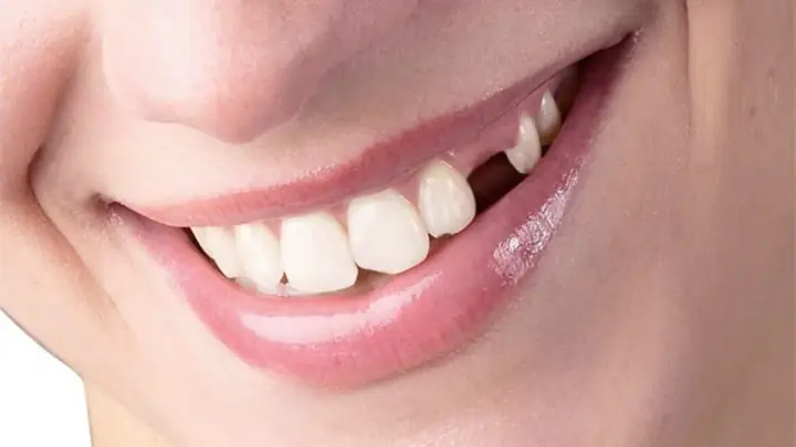 Mơ Bị Gãy Răng Có Điềm Báo Gì? Giải Mã Ý Nghĩa Theo Từng Trường Hợp Mơ Bị Gãy Răng Có Điềm Báo Gì? Giải Mã Ý Nghĩa Theo Từng Trường Hợp