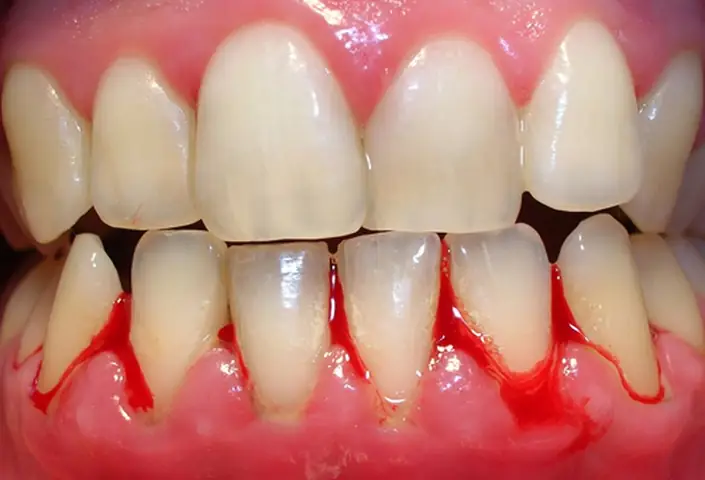 Mơ Thấy Chảy Máu Răng Đánh Con Gì? Giải Mã Điềm Báo Và Con Số May Mắn Chi Tiết Mơ Thấy Chảy Máu Răng Đánh Con Gì? Giải Mã Điềm Báo Và Con Số May Mắn Chi Tiết