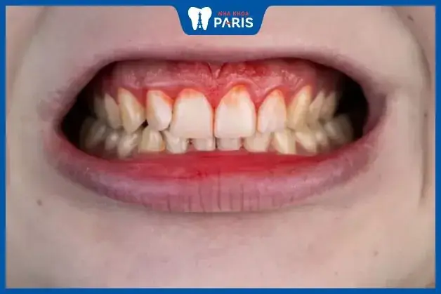 Mơ Thấy Chảy Máu Răng Đánh Con Gì? Giải Mã Điềm Báo Và Con Số May Mắn Chi Tiết Mơ Thấy Chảy Máu Răng Đánh Con Gì? Giải Mã Điềm Báo Và Con Số May Mắn Chi Tiết