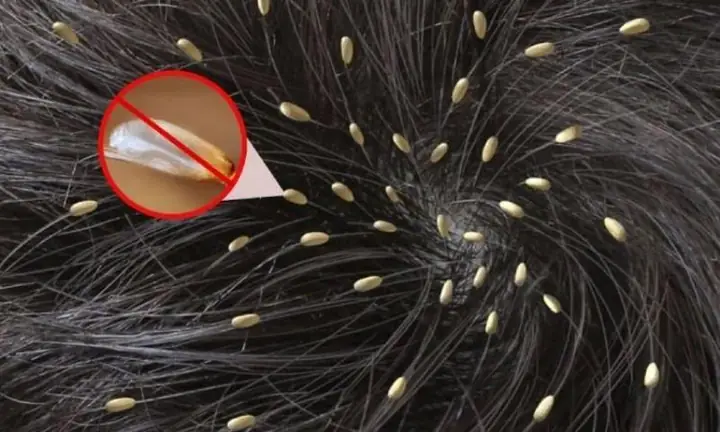 Mơ Thấy Chấy Trên Đầu Đánh Con Gì Mơ Thấy Chấy Trên Đầu Đánh Con Gì