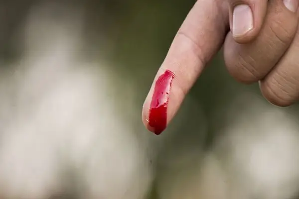 Giải Mã Giấc Mơ Thấy Đứt Ngón Tay Chảy Máu: Ý Nghĩa, Dự Báo Và Cách Đối Phó