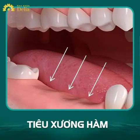 Nằm Mơ Thấy Gãy Răng Cửa Không Chảy Máu