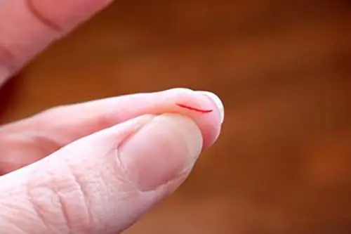 Nằm Mơ Thấy Người Khác Đứt Tay Chảy Máu