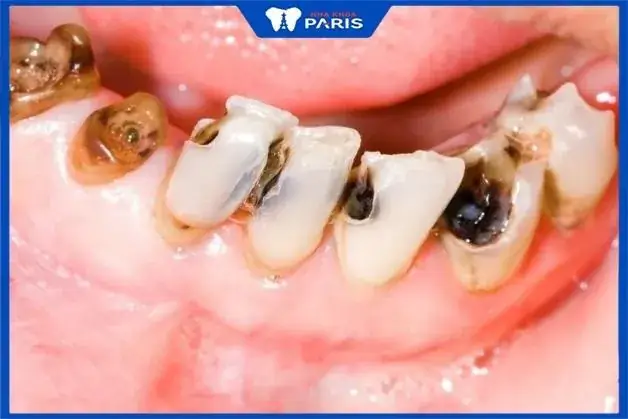 Nằm Mơ Thấy Nhổ Răng Cho Người Khác: Ý Nghĩa Và Điềm Báo Nằm Mơ Thấy Nhổ Răng Cho Người Khác: Ý Nghĩa Và Điềm Báo