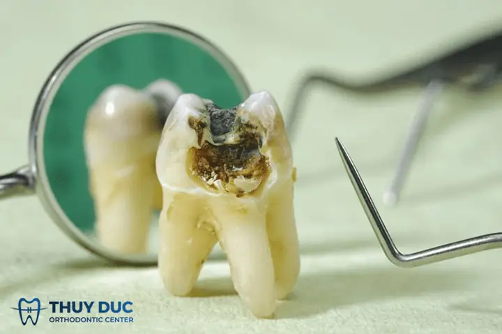 Nằm Mơ Thấy Nhổ Răng Sâu Là Điềm Báo Gì Nằm Mơ Thấy Nhổ Răng Sâu Là Điềm Báo Gì
