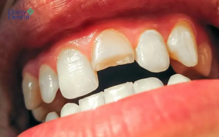 Giải Mã Giấc Mơ Thấy Răng Bị Mẻ Và Các Con Số May Mắn Giải Mã Giấc Mơ Thấy Răng Bị Mẻ Và Các Con Số May Mắn