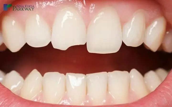 Giải Mã Giấc Mơ Thấy Răng Bị Mẻ Và Các Con Số May Mắn Giải Mã Giấc Mơ Thấy Răng Bị Mẻ Và Các Con Số May Mắn