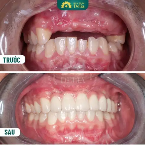 Nằm Mơ Thấy Rụng Răng Chảy Máu Đánh Con Gì Nằm Mơ Thấy Rụng Răng Chảy Máu Đánh Con Gì
