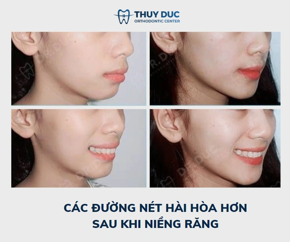 100+ Những Hình Ảnh Răng Hô 2026 Full Hd Mới Nhất — Bạn Sẽ Thấy Đẹp Như Thế Nào? 100+ Những Hình Ảnh Răng Hô 2026 Full Hd Mới Nhất — Bạn Sẽ Thấy Đẹp Như Thế Nào?