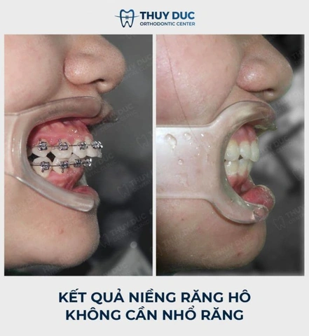 100+ Những Hình Ảnh Răng Hô 2026 Full Hd Mới Nhất — Bạn Sẽ Thấy Đẹp Như Thế Nào? 100+ Những Hình Ảnh Răng Hô 2026 Full Hd Mới Nhất — Bạn Sẽ Thấy Đẹp Như Thế Nào?