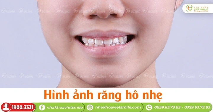 100+ Những Hình Ảnh Răng Hô 2026 Full Hd Mới Nhất — Bạn Sẽ Thấy Đẹp Như Thế Nào? 100+ Những Hình Ảnh Răng Hô 2026 Full Hd Mới Nhất — Bạn Sẽ Thấy Đẹp Như Thế Nào?