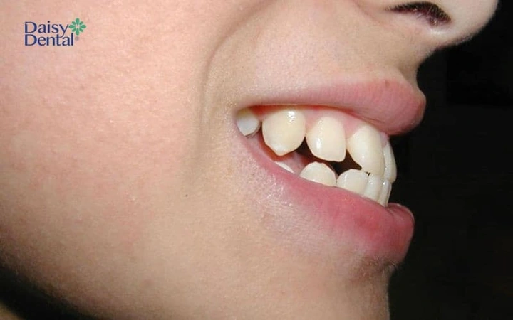 100+ Những Hình Ảnh Răng Hô 2026 Full Hd Mới Nhất — Bạn Sẽ Thấy Đẹp Như Thế Nào? 100+ Những Hình Ảnh Răng Hô 2026 Full Hd Mới Nhất — Bạn Sẽ Thấy Đẹp Như Thế Nào?