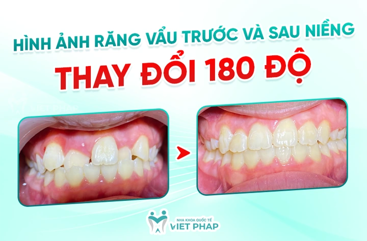 100+ Những Hình Ảnh Răng Hô 2026 Full Hd Mới Nhất — Bạn Sẽ Thấy Đẹp Như Thế Nào? 100+ Những Hình Ảnh Răng Hô 2026 Full Hd Mới Nhất — Bạn Sẽ Thấy Đẹp Như Thế Nào?