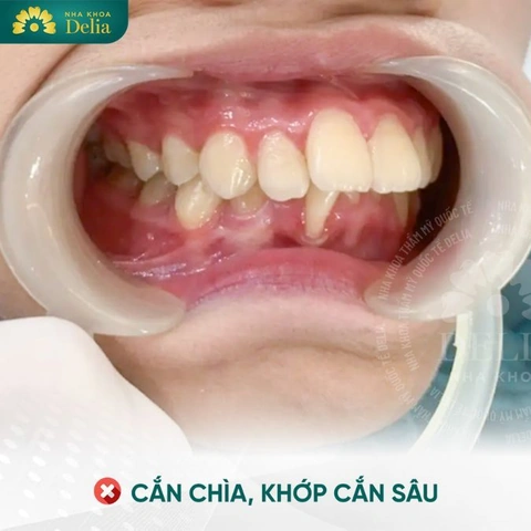 100+ Những Hình Ảnh Răng Hô 2026 Full Hd Mới Nhất — Bạn Sẽ Thấy Đẹp Như Thế Nào? 100+ Những Hình Ảnh Răng Hô 2026 Full Hd Mới Nhất — Bạn Sẽ Thấy Đẹp Như Thế Nào?