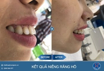 100+ Những Hình Ảnh Răng Hô 2026 Full Hd Mới Nhất — Bạn Sẽ Thấy Đẹp Như Thế Nào? 100+ Những Hình Ảnh Răng Hô 2026 Full Hd Mới Nhất — Bạn Sẽ Thấy Đẹp Như Thế Nào?
