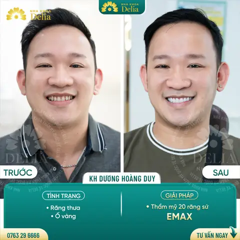 Răng Cửa Thưa Tướng Số Răng Cửa Thưa Tướng Số
