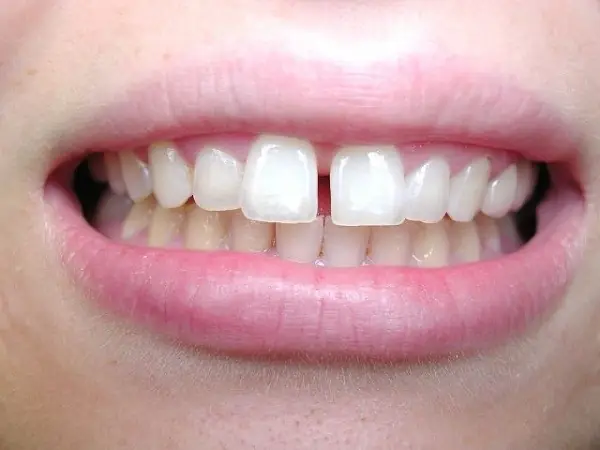 Răng Cửa Thưa Tướng Số Răng Cửa Thưa Tướng Số