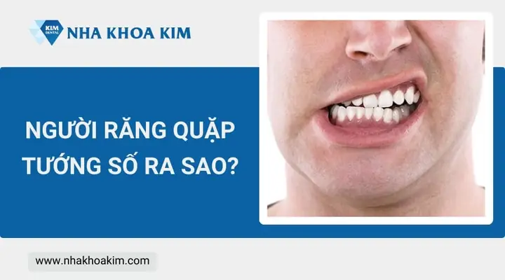 Răng Quặp Vào Trong Tướng Số Răng Quặp Vào Trong Tướng Số
