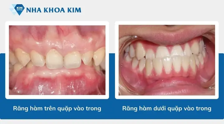 Răng Quặp Vào Trong Tướng Số Răng Quặp Vào Trong Tướng Số
