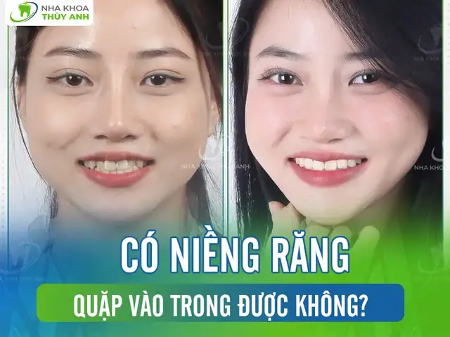 Răng Quặp Vào Trong Tướng Số Răng Quặp Vào Trong Tướng Số