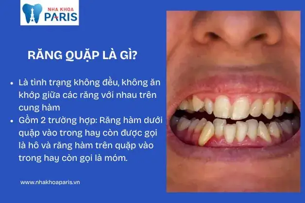 Răng Quặp Vào Trong Tướng Số Răng Quặp Vào Trong Tướng Số