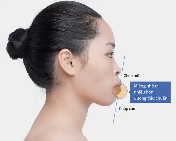 Tướng Cằm Nhô Ra Phía Trước Tướng Cằm Nhô Ra Phía Trước