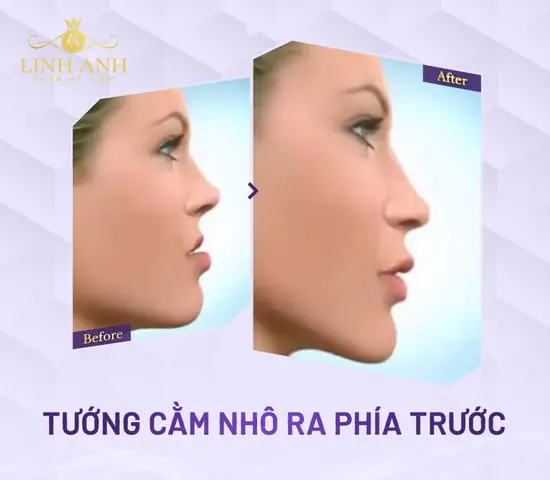 Tướng Cằm Nhô Ra Phía Trước Tướng Cằm Nhô Ra Phía Trước