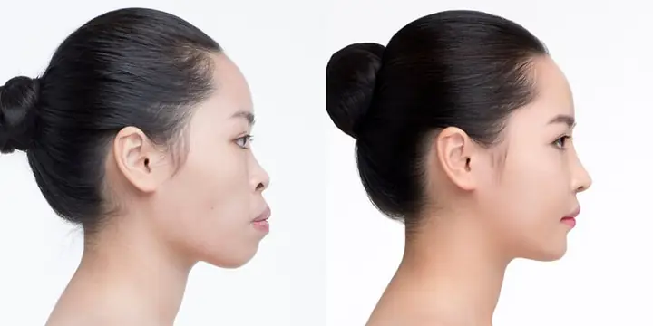 Tướng Cằm Nhô Ra Phía Trước Tướng Cằm Nhô Ra Phía Trước