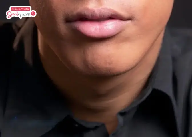 Tướng Miệng Cá Trê Tướng Miệng Cá Trê