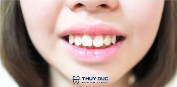 Tướng Người Răng Hô Tướng Người Răng Hô